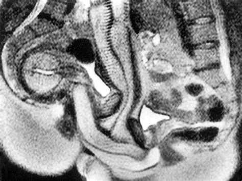 mri セックス|Magnetic resonance imaging of male and female genitals during。